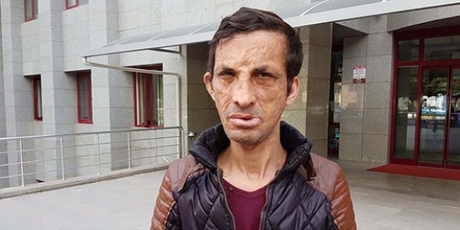 Yüz nakli olan kişi cinayetle suçlanıyor