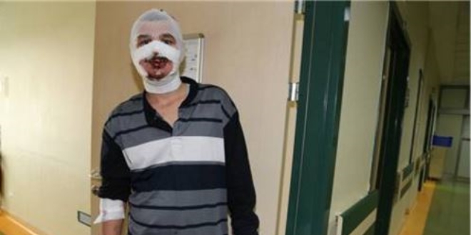 Isınmak için sobaya benzin dökünce elleri ve yüzü yandı