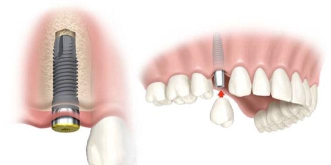 Dişimize implant diye domuz kemiği takılıyormuş