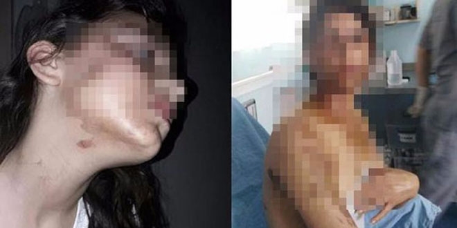 Eve gizlice girerek, uyuyan 2 kişinin yüzüne asit döktü