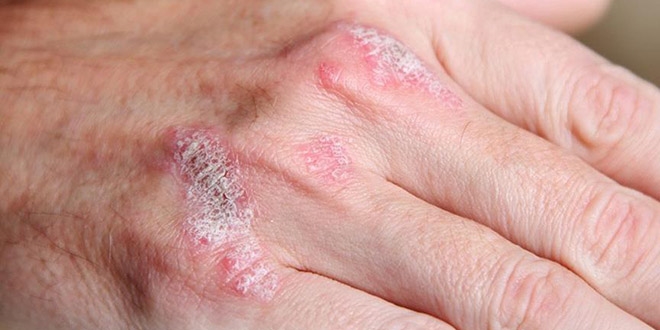 Sedef hastalar� i�in 'eklem romatizmas�' uyar�s�