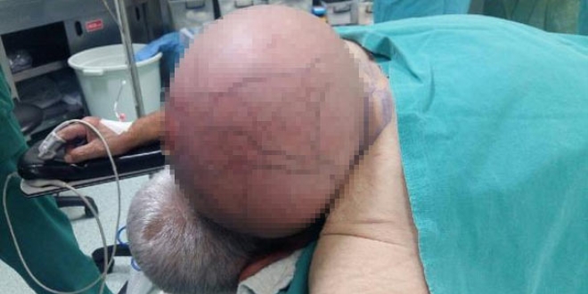 Doktorlar bile şok oldu! 50 yıldır ensesinde taşıyordu