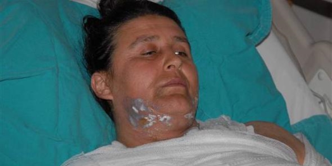 Kocasının sevgilisi tarafından üzerine sıcak su döküldü