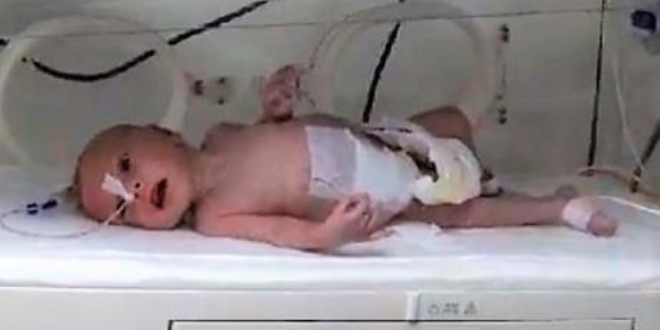 Yeni doğan bebeğin karnından 1 kilo 300 gram kitle çıkarıldı