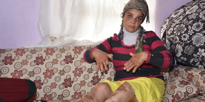 Elleri ve kolları her geçen gün eriyor