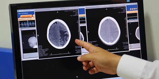 'Beyin damarndaki tkanklkta 'stent' hayat kurtaryor