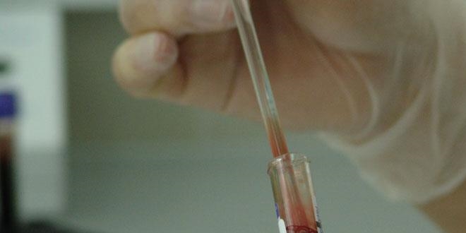 Kadınlar arasında akciğer kanseri yükselişte