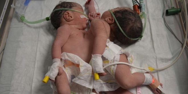 Konya'da ameliyatla ayrlan Suriyeli siyam ikizlerinden biri ld