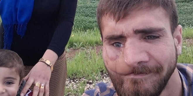 38 kez ameliyat oldu y�z� d�zelmedi!