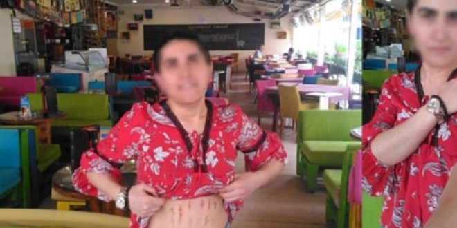 Lazer epilasyonun ardından vücudu bu hale geldi