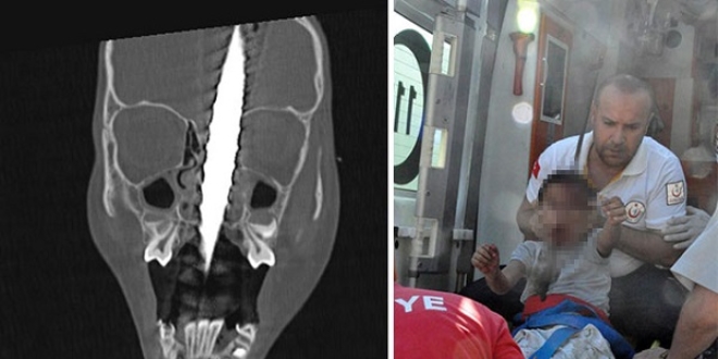 Başına saplanan demiri 7 doktor, 5 saatlik operasyonla çıkardı!