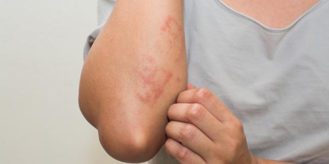 T�rkiye'de 2 milyon ki�i sedef hastas�