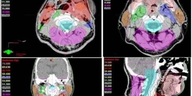 Kanser tedavisinde 'Yapay Zeka' ba�ar�s�