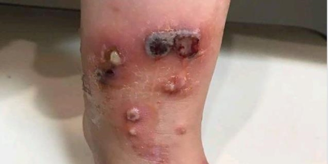 'Şarbon antibiyotikle tedavi edilen bir hastalıktır'