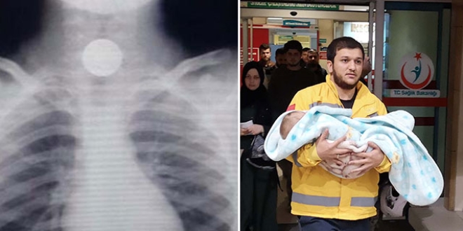 1 yaşındaki bebeğin boğazına 50 kuruş takıldı