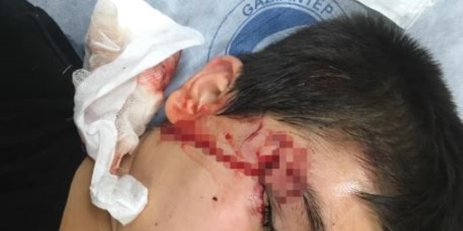 Pitbul'un saldırdığı çocuğu, köpeğin ağzından zor aldılar