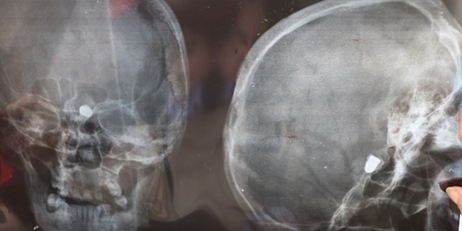 45 y�ld�r kafas�nda kur�unla ya��yor