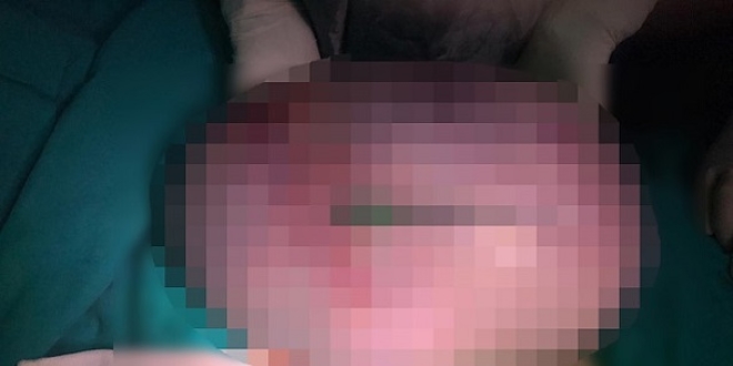 Kilo aldığını sandı ama 45 santimetrelik kist çıktı