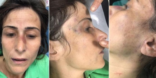 Eşinin kemiklerini kıran doktora 'haksız tahrik' indirimi!