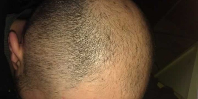 Saç dökülmesi sorun olmaktan çıkıyor