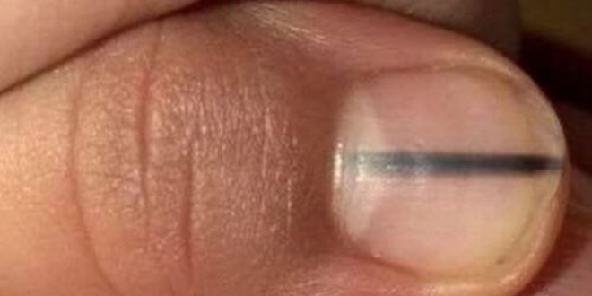 Tırnaklardaki koyu renk çizgiler hastalık habercisi