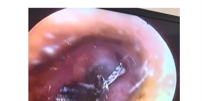 Kulağından çıkan canlı, doktorları bile şaşkına çevirdi