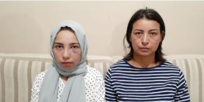 17 yaşındaki kızı köpek yüzünden darp ettiler