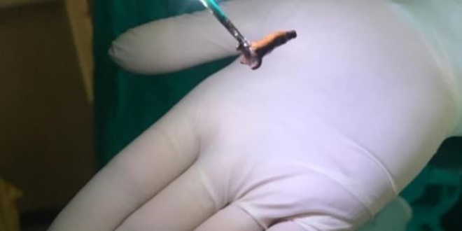 Çiğnediği karanfil akciğerine kaçınca ölümden döndü