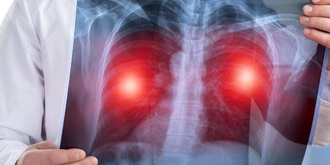 Hava kirlilii akcier kanseri riskini arttryor