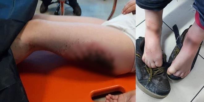 Kartopu oynarken yanan �ocuklara doku nakli yap�lacak