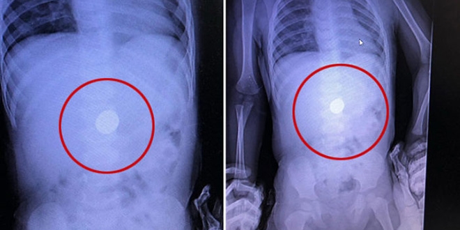 R�ntgende tespit edildi, do�al yolla ��kmas� beklenecek