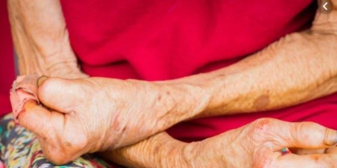 Türkiye'de 2019'da 2 yeni cüzzam vakası görüldü