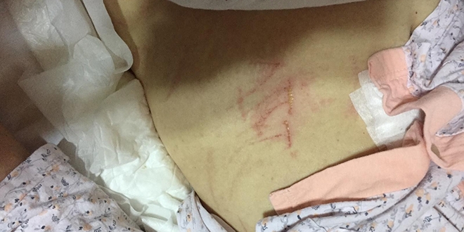 Yoğun bakımdaki hastanın karnına kesici aletle 'ATT' yazıldı