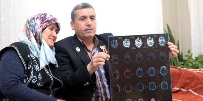 28 yıldır başındaki 14 şarapnel parçasıyla yaşıyor