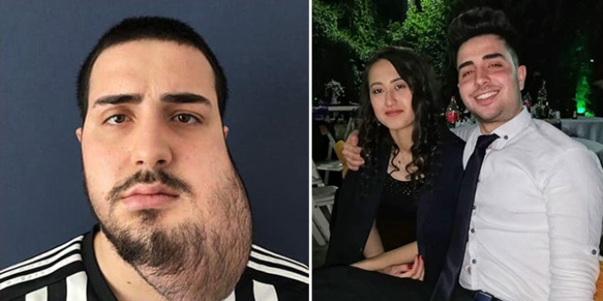 Çenesinde 420 gam tümör alındı, hayata yeniden döndü