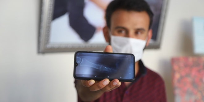 16 yıl önce parmağına batan iğne çıkarılacak