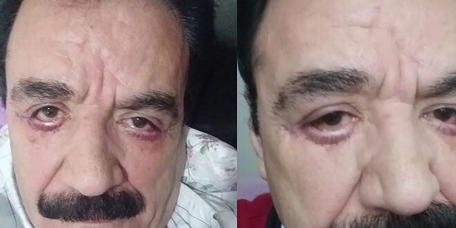 İstanbul'da göz doktoru 'Hatalı estetik' iddiası