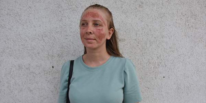 Güzellik merkezinde yüzünde yanıklar oluşan kişi polise başvurdu