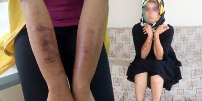 Lazer epilasyon yaptıran kadının vücudunda yanıklar oluştu