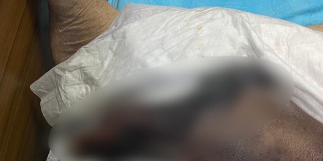 Başhekim uyardı... Virüse yakalandı, kangren oldu!