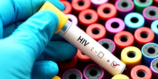 Prof. Dr. nan: HIV artk lmcl deil kronik bir hastalk