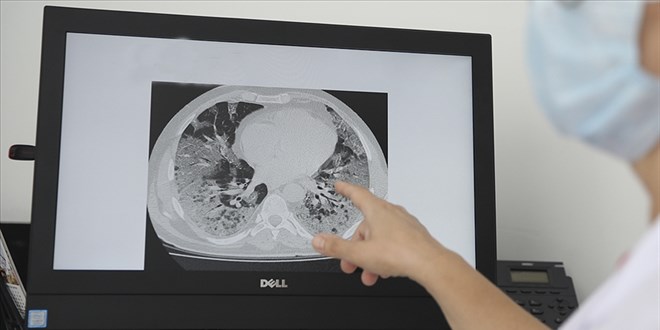Kovid-19 salgını zatürre kaynaklı ölümleri artırdı