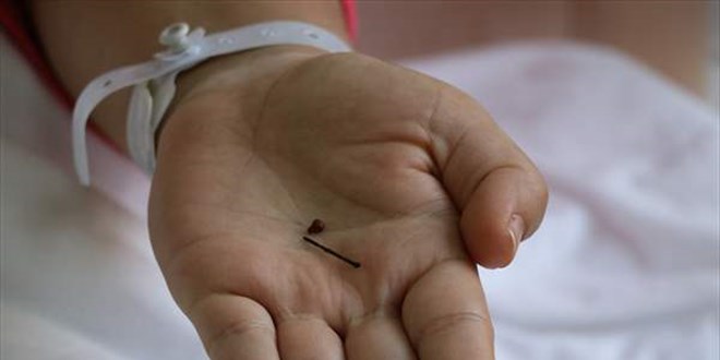 Aydınlı genç kız bebekken yuttuğu toplu iğneden 17 yıl sonra kurtuldu