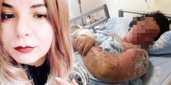 Yanlış antibiyotik kullanımı hayatını zindana çevirdi!