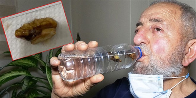 Koronavirüsten şüphelenildi, akciğerinden ceviz çıktı