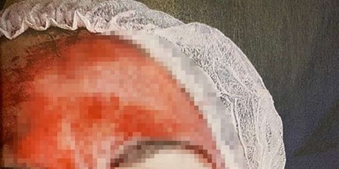 Güzellik merkezinde tedavi sonrası yüzü kanlar içinde kaldı