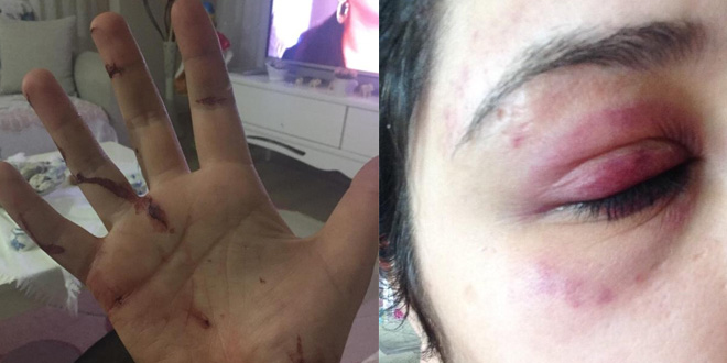 Alkollü avukat, kız arkadaşını feci şekilde darp etti