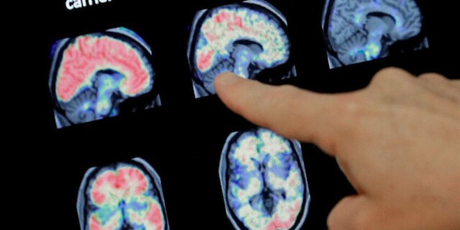 Kovid-19 grlen her 3 kiiden biri psikolojik ya da nrolojik rahatszlk yayor