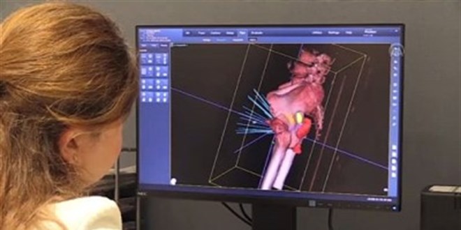 Radyocerrahi cihazı 'Uzay Neşteri' kanser tedavisinde etkin rol üstleniyor