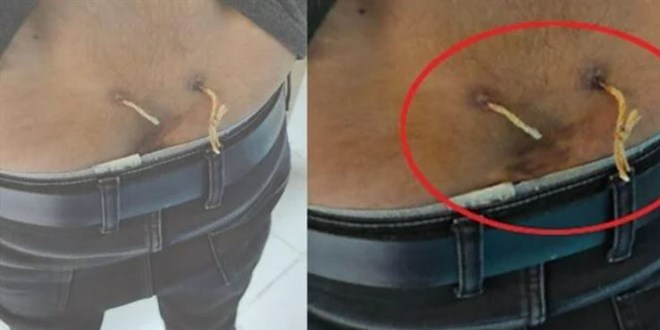 'Alternatif tıp' adı altında işkence: Çamaşır ipiyle bel tedavisi